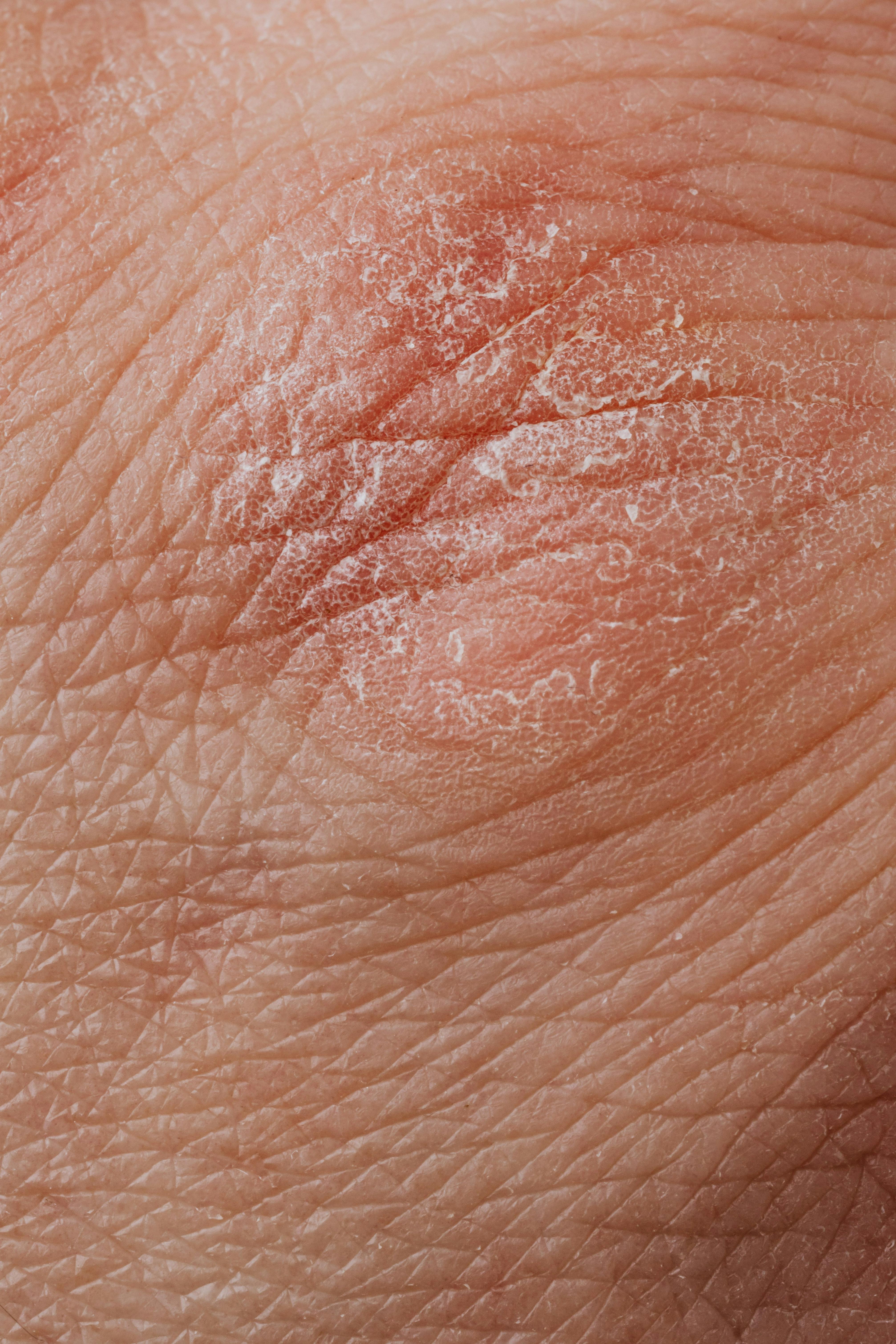 Tratamento de dermatologia clínica