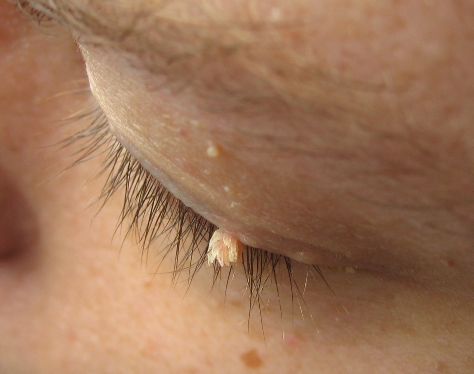 Filiform wart: Growth on eyelid