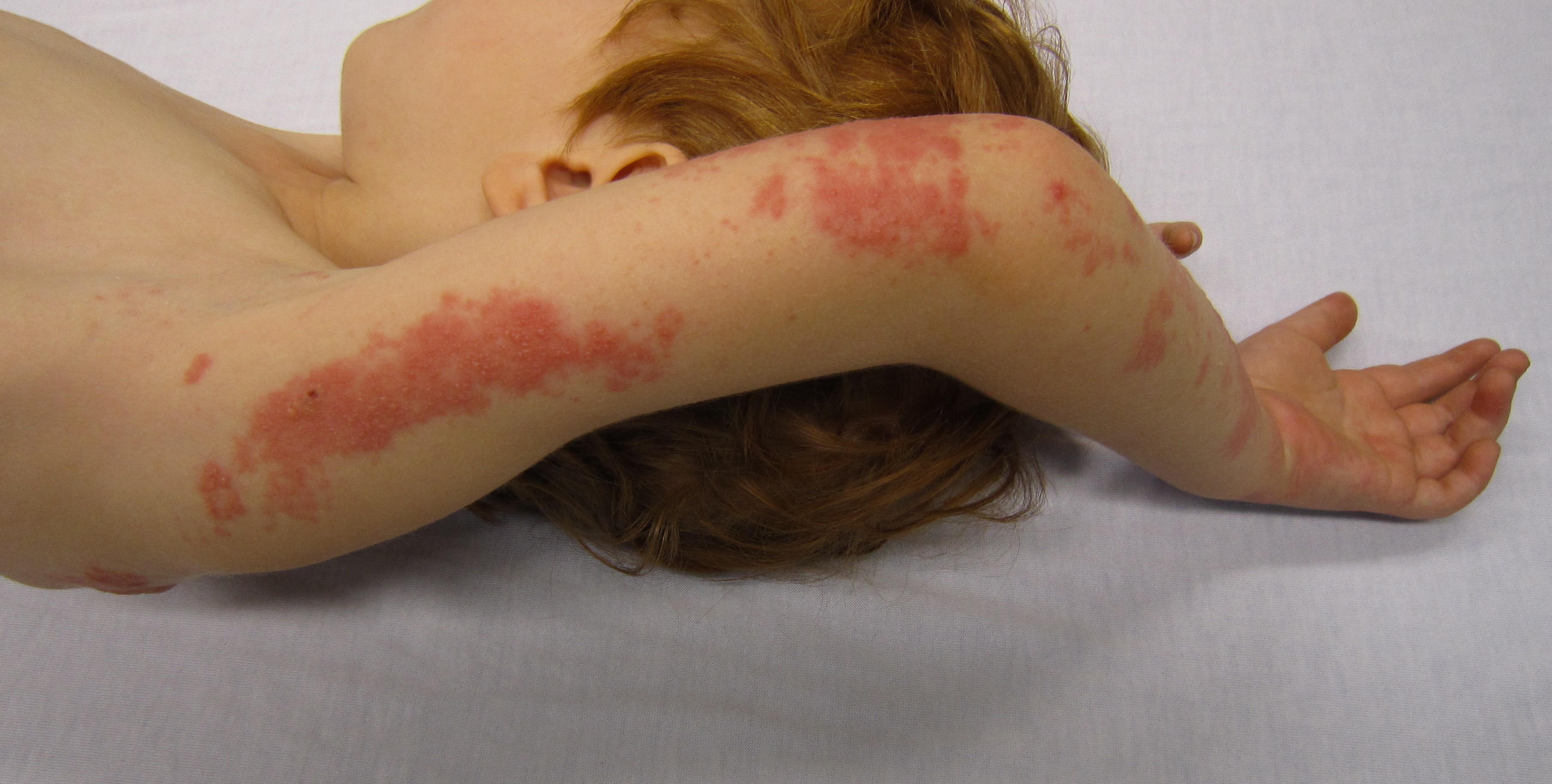 Child's arm with inflammatory skin condition showing reddish rash, demonstrating symptoms requiring dermatological treatment
