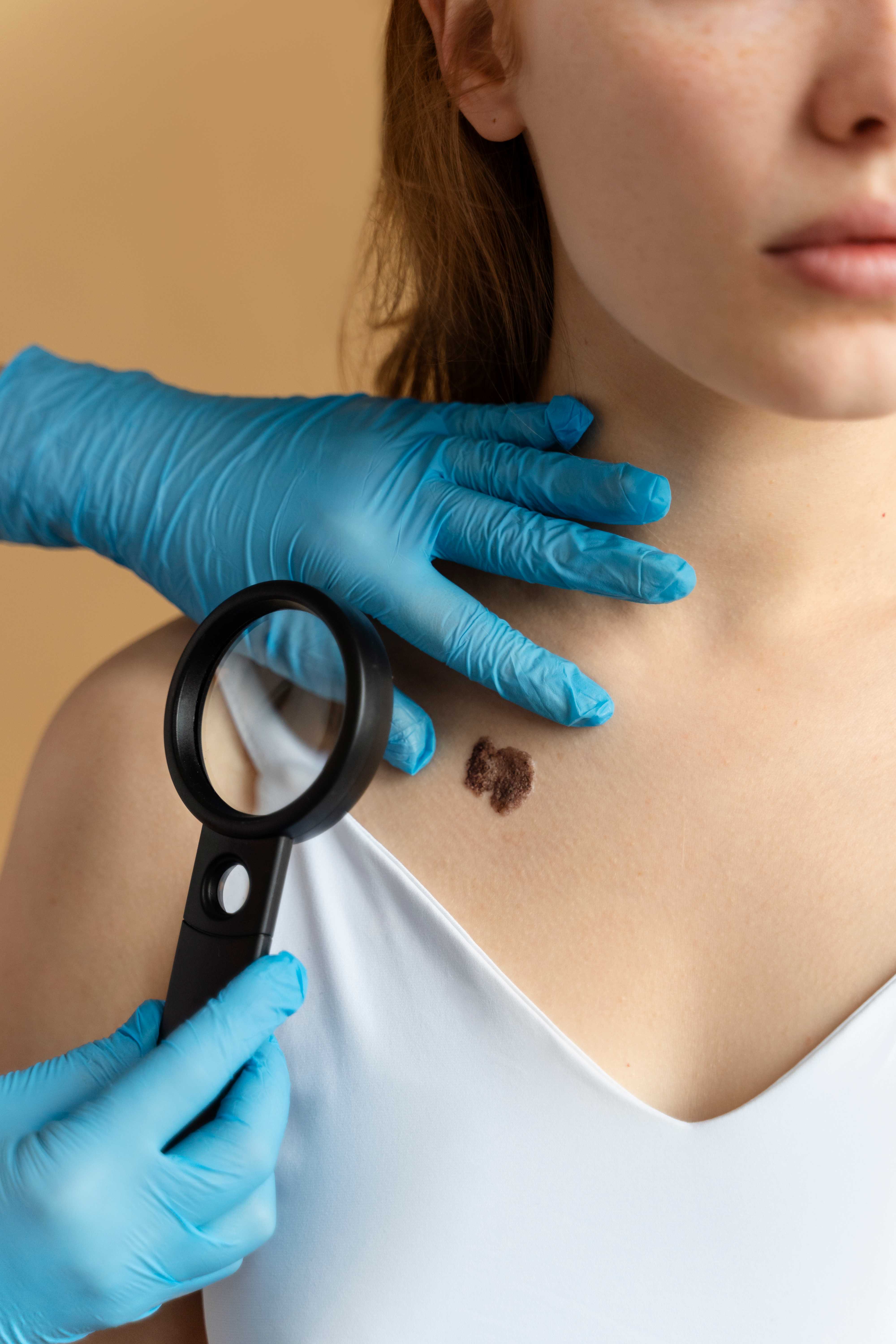 Dermatological examination of a skin lesion with magnifying glass, performed by a dermatologist wearing blue medical gloves