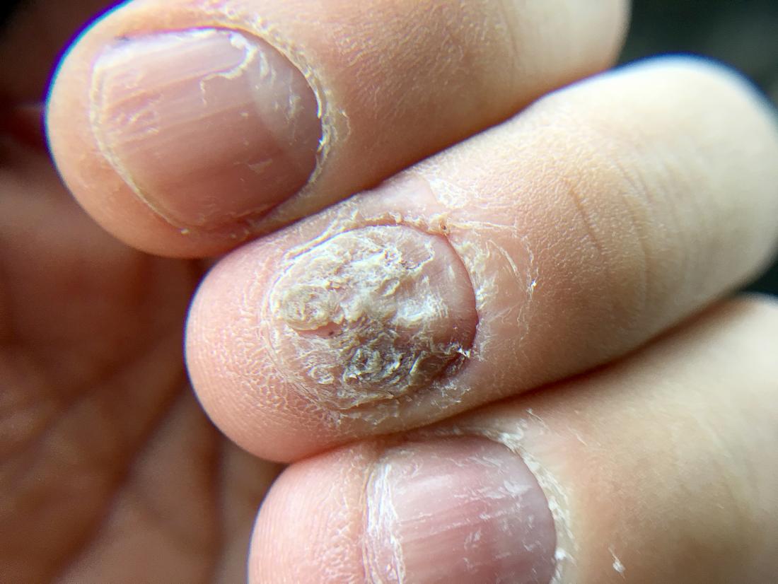Nail fungus condition showing affected fingernails