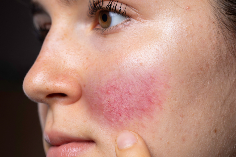 Rosacea: Inflammatory skin condition