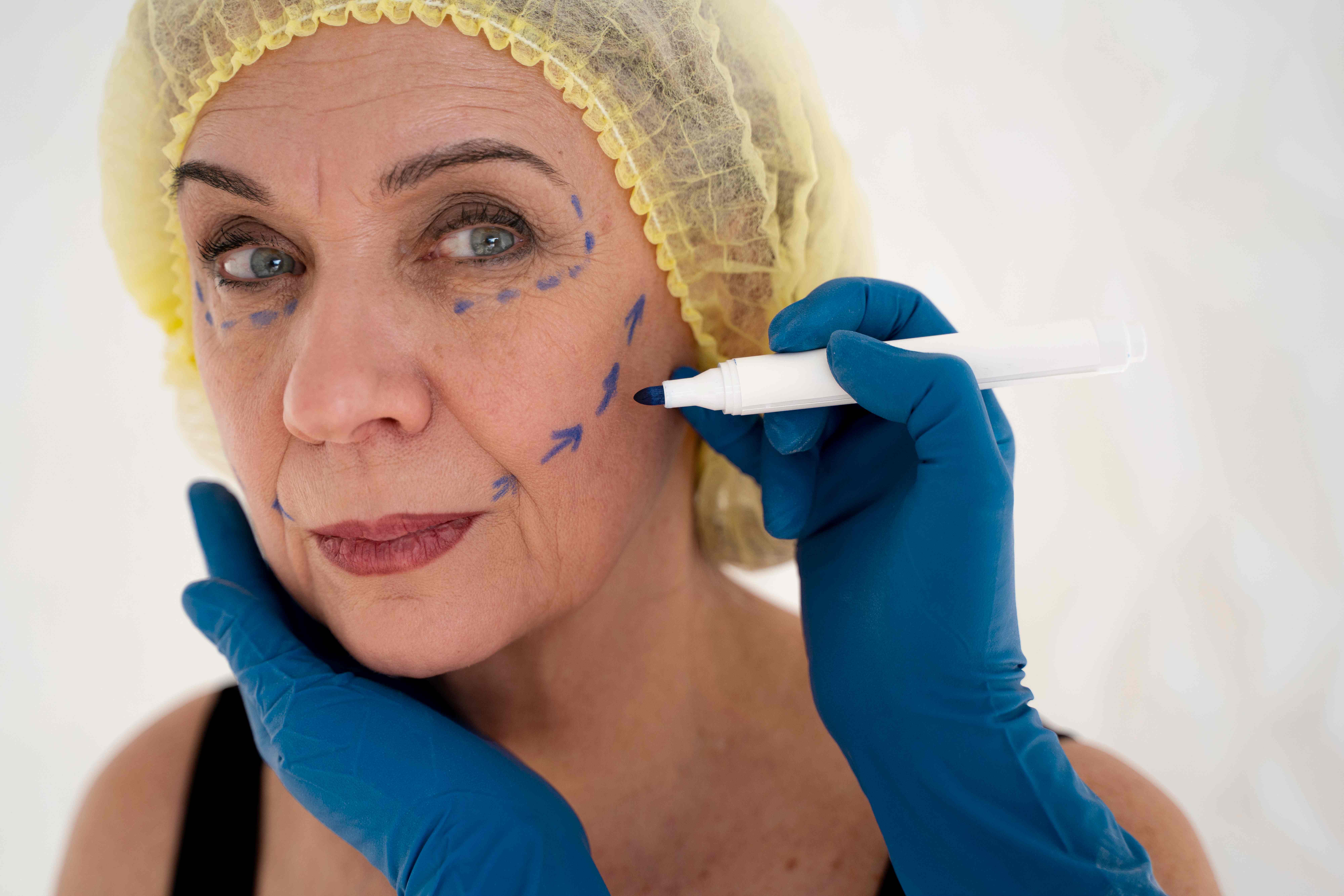 Avaliação facial personalizada em paciente sênior com marcações para procedimento de rejuvenescimento, demonstrando planejamento preciso de tratamento